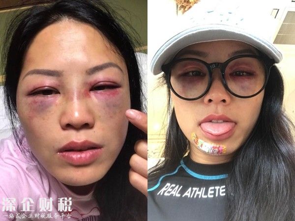 女星錄節(jié)目被暴打 只見臉上紅腫嚇人險(xiǎn)些被毀容