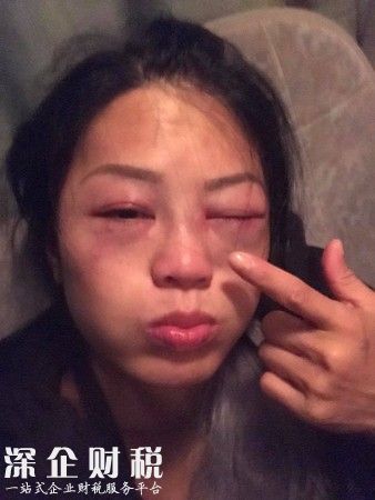 女星錄節(jié)目被暴打 只見臉上紅腫嚇人險(xiǎn)些被毀容