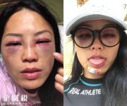 節(jié)目被暴打 只見臉上紅腫嚇人險(xiǎn)些被毀容